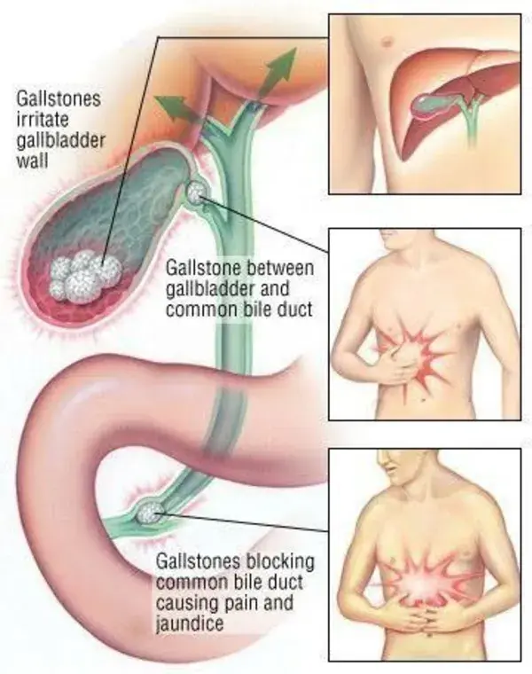 Cholelithiasis Symptoms and Treatment Nurses Note Link👇