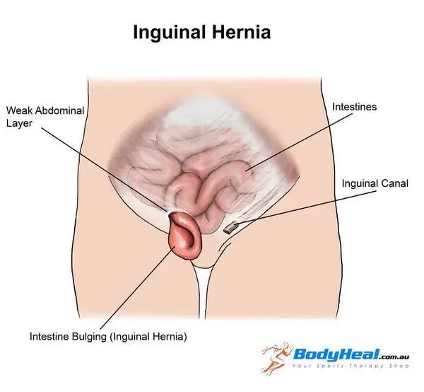 What Is Inguinal Hernia? Causes, Symptoms & Treatment Options