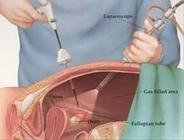 Endometriosis Resolved