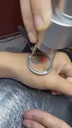 Laser tattoo removal 🔥🔥🔥