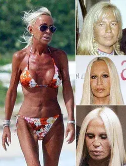 Plastic Surgeries Gone Wrong | List of Celebs Who Look Worse After Cosmetic Surgery