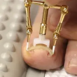 Este aparato repara las uñas encarnadas