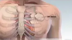 Cardiac Resynchronization therapy