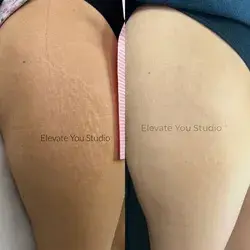 Stretchmarks Removal by Elevate you studio