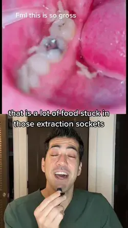 What happens if Food goes into extraction socket after wisdom, teeth surgery? ##wisdomtooth##wisdom