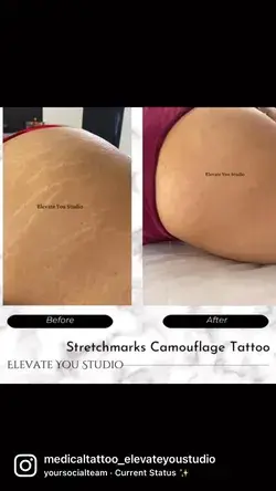 Stretchmarks solution