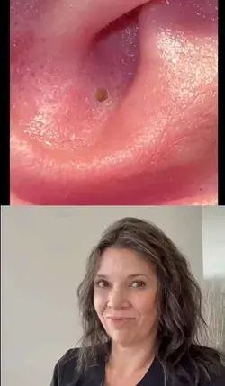 Ear Blackhead Removal!