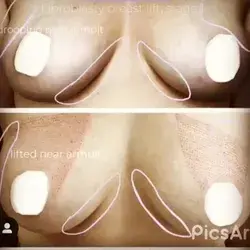 Fibroblast skin tightening breast lift