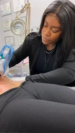 Microneedling