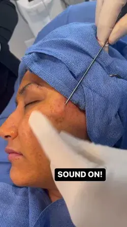 One of the BEST Treatments for Deep Acne Scars! 🤩