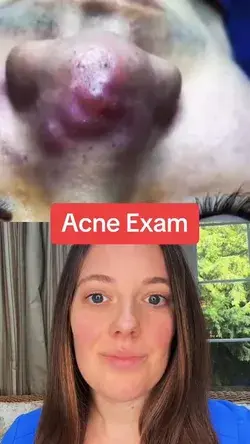 What Causes Cystic Acne?