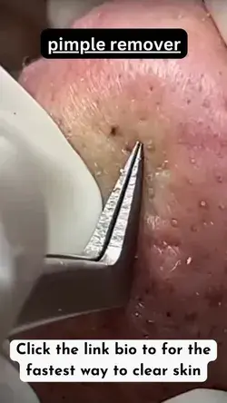 pimple removal 😐