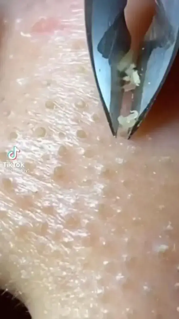 Blackheads removal video