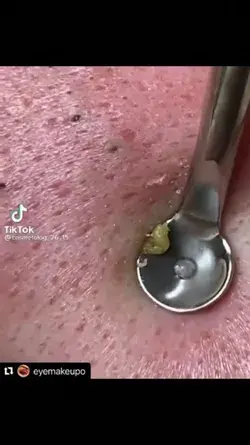 Blackheads removal so satisfying