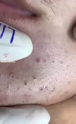 Blackheads