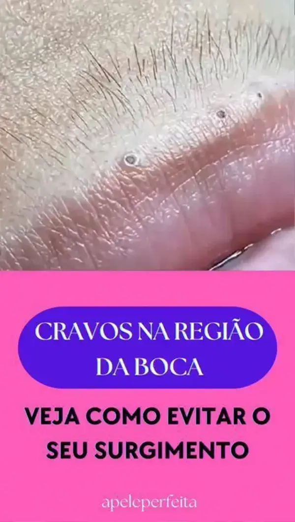 Veja como evitar o surgimento de cravos ao redor da boca