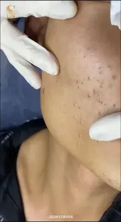 Blackheads