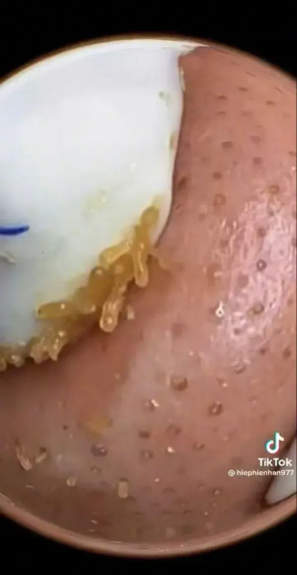 Blackheads extraction removal