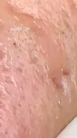 Pimple Popping | Blackheads Removal No. 71