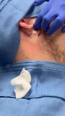 Sebaceous Cyst Excisions are Fun and Easy!