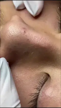 Pimple popping and Blackhedads removal Videos