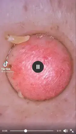 Blackheads extraction