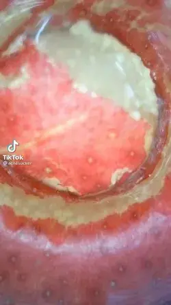 Blackheads extraction