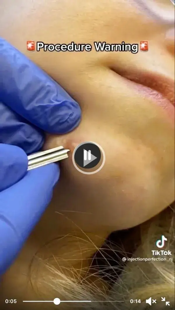 Blackheads extraction satisfyin