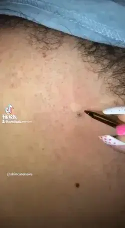 Incredibly ingrown hair 😬