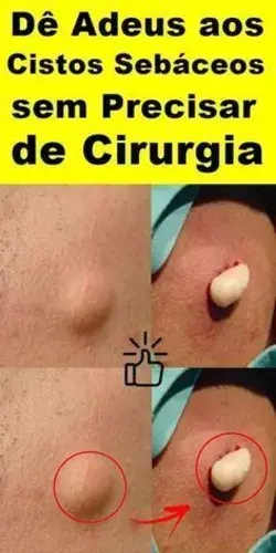 Como eliminar las verrugas del cuello con estos remedios caseros