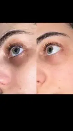 Easiest way to reduce dark circles/best natural treatment of dark circles at home