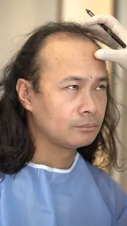 Hair Transplant - Long Hair Center