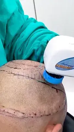 Hair Transplant Clinic