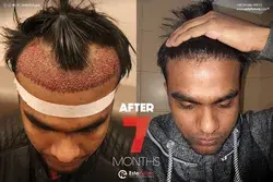 Hair Transplant Result After 7 Months at Este Future in Turkey