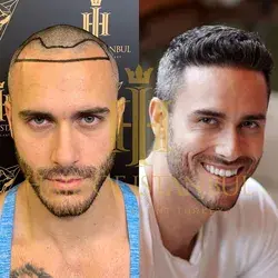 Hair Transplant by Hair of Istanbul