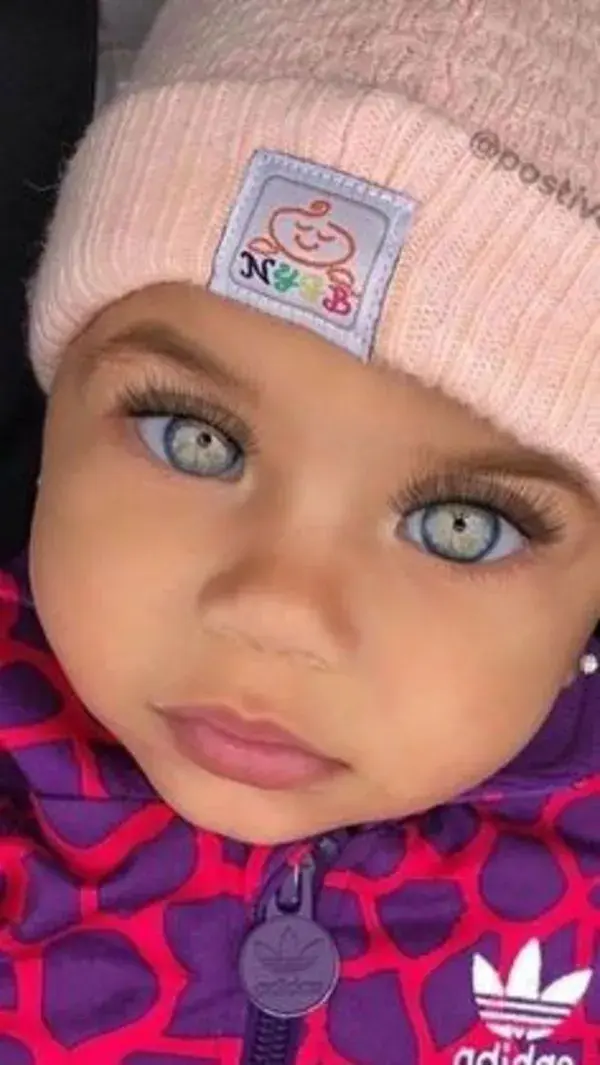 The Odds Were Always Against This 'Doll-Like' Baby With Black Eyes. Look At Her 5 Years Later