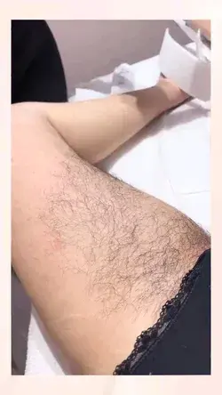 Hair removal #satisfying #satisfyingvideos #hairremoval #hairremove