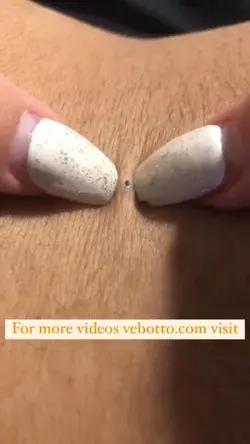 Blackheads Removal