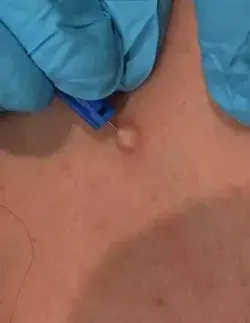 Cyst