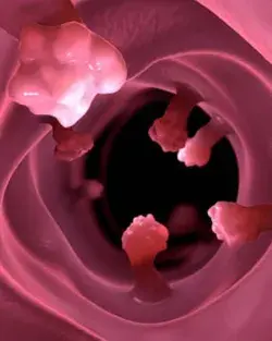 What is colorectal cancer?