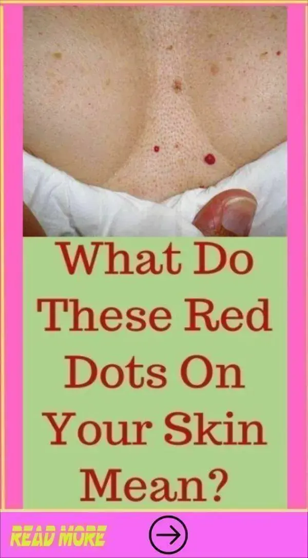 What Do These Red Dots On Your Skin Mean?