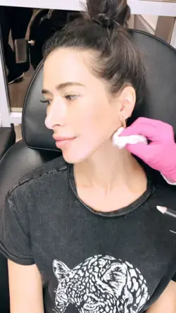 Jawline Filler 🥰