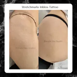 Have you tried everything, nothing worked for your stretchmarks ? Medical tattoo can help !