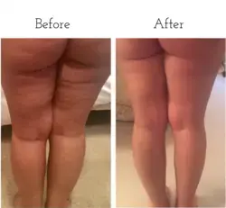 #FasciaBlaster user images