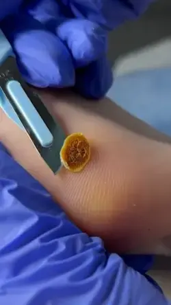 The process of warts removal 🤕