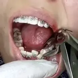 Orthodontic teeth extraction