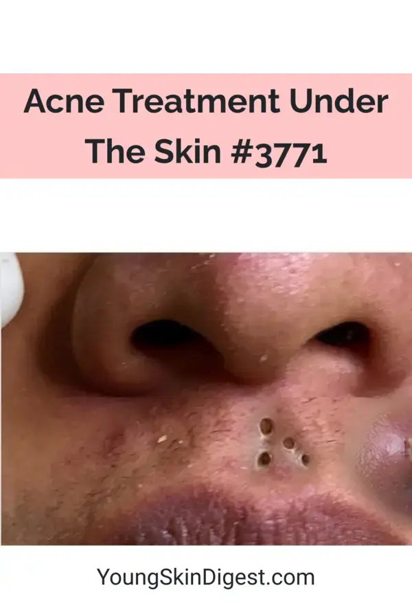 Acne Treatment Under The Skin #3771