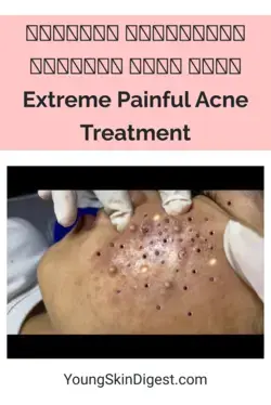 𝗘𝘅𝘁𝗿𝗲𝗺𝗲 𝗕𝗹𝗮𝗰𝗸𝗵𝗲𝗮𝗱 𝗥𝗲𝗺𝗼𝘃𝗮𝗹  𝗦𝗸𝗶𝗻 𝗖𝗮𝗿𝗲  Extreme Painful  Acne Treatment