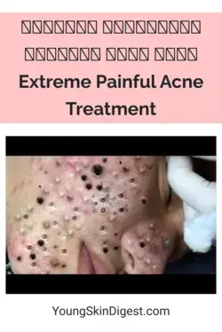 𝗘𝘅𝘁𝗿𝗲𝗺𝗲 𝗕𝗹𝗮𝗰𝗸𝗵𝗲𝗮𝗱 𝗥𝗲𝗺𝗼𝘃𝗮𝗹  𝗦𝗸𝗶𝗻 𝗖𝗮𝗿𝗲  Extreme Painful  Acne Treatment