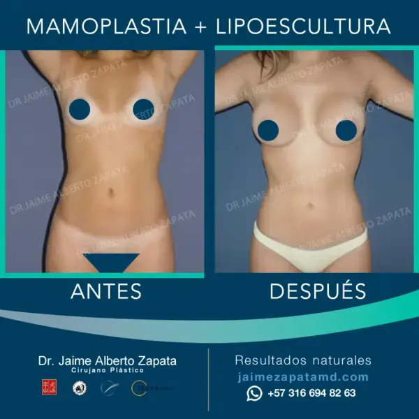 Mamoplastia + Lipoescultura